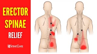 How to Fix Erector Spinae Pain FOR GOOD [upl. by Ynnavoig]