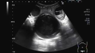 Ultrasound Video showing Haematometrium with Hydrosalpinx [upl. by Bilek]