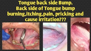 Tongue back side Bump back side of Tongue bump burningitchingpain pricking and cause irritation [upl. by Kciremed]