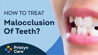 What is Malocclusion of Teeth  How to Treat Malocclusion [upl. by Ahsekim277]