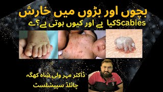 Scabies kiya cheez hai aur kis tarhan hoti hai  Kharish Khatam Karne Ka Tarika  Scabies Ka Ilaj [upl. by Cohlette]