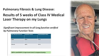 Update on my results of Laser Therapy for lungs [upl. by Nahsrad]