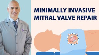 Surgeon QampA MinimallyInvasive Mitral Valve Repair with Dr Marc Gerdisch [upl. by Yznil]