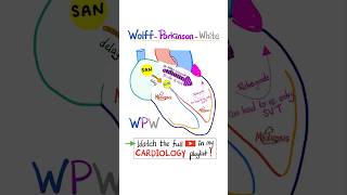 Cardiac Arrhythmia WolffParkinson White WPW Syndrome science cardio nurse doctor mbbs [upl. by Schlessinger]