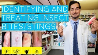 Insect Bites and Stings  Insect Bites Treatment  How to Treat Insect Bites and Stings  2018 [upl. by Federica]