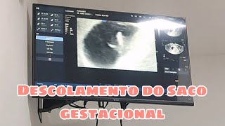 Descolamento do saco gestacional primeiras ecografias do baby [upl. by Isbella]