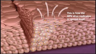 Cervical Cancer Disease Progression and Prevention Screen Manage and Diagnose More Accurately [upl. by Jacques826]