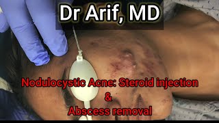 Nodulocystic acne Injection amp Abscess removal DrArifMDDermatologist acnetreatment acne dermatology [upl. by Caesaria112]