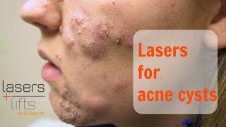 Treating acne cysts [upl. by Orlantha]