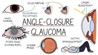 Understanding Acute Angle Closure Glaucoma [upl. by Alberto]