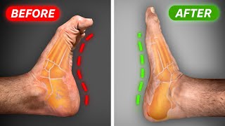 Fix High Arches amp Supinated Feet FAST in 30 Days [upl. by Eissehc]