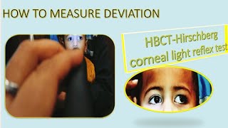 Hirschberg Test Hirschberg Corneal Reflex Test Hirschberg Test Interpretation HBCT Test HBRTCLR [upl. by Yessac571]