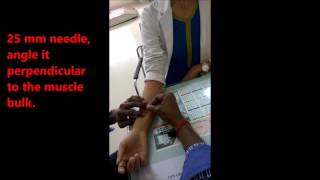 Dry Needling Flexor Pollicis longus [upl. by Idzik]