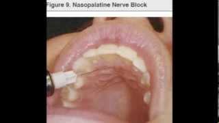 NP nasopalatine nerve block [upl. by Tad]