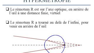 BIOPHYSIQUE les ametropies spheriques [upl. by Caras]