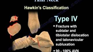 Talus fracture Hawkins Classificaiton  Everything You Need To Know  Dr Nabil Ebraheim [upl. by Adehsar]