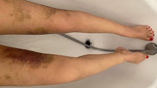 Mes jambes 10 jours après lopération du lipoedème VLOG 12 [upl. by Radmilla509]