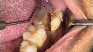 What happens if you dont get a crown after a root canal [upl. by Gney57]