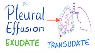 Lights Criteria amp Pleural Effusions  MEDZCOOL [upl. by Misti]