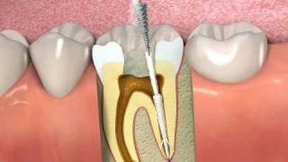 ProPoint How to obturate a root canal with SmartSeal [upl. by Eelana]