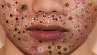 Big Cystic Acne Blackheads Extraction Blackheads amp Milia Whiteheads Removal Pimple Popping  3705 [upl. by Maite]