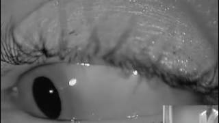 Dramatic Right Posterior Canalithiasis with Gaze Separation [upl. by Riordan]