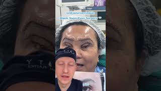 Shocking Black Swan Eye Surgery Trend  Plastic Surgeon Reacts [upl. by Ennalorac814]