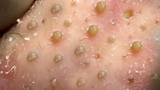 Relax Every Day With Loan Nguyen Spa  Acne Treatment Pimple Popping 27 [upl. by Scarlett]