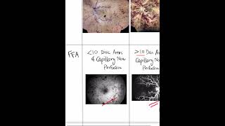 Ischemic Vs NonIschemic Central Retinal Vein Occlusion Shorts [upl. by Ferdinana638]