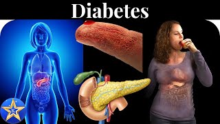 Diabetes Causes Diagnosis and Treatment [upl. by Enitsud]