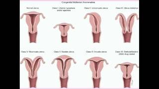 Congenital Uterine Abnormalities  CRASH Medical Review Series [upl. by Zigmund]