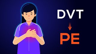 Overview of Acute Pulmonary Embolism in adults From DVT to PE [upl. by Pallaton550]