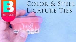 BRACES EXPLAINED Color and Steel Ligature Ties [upl. by Harbard]