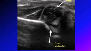 DDH developmental dysplasia of hip congenital hip dislocation CHD [upl. by Nauqe]