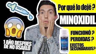 Por esto dejé el minoxidil 5 meses de tratamiento VICTOR CABALLERO [upl. by Towroy475]