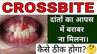 Crossbite Dental Condition 🦷  Cause Problem and Treatment [upl. by Elspeth]