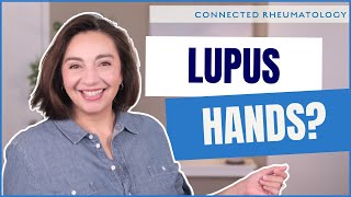 The 3 ways Lupus can affect your hands  a Rheumatologist explains [upl. by Enelrak303]