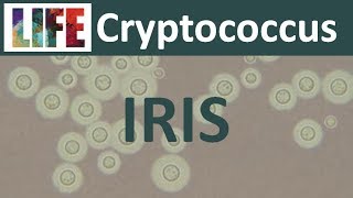 Cryptococcal IRIS [upl. by Eniamrehs675]