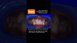 Invisalign makeover for Class 3 crossbite  Before and after time lapse video [upl. by Amlas]