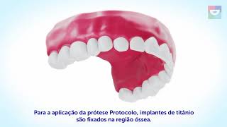 Protocolo Com Carga Imediata  Como Funciona o Protocolo Com Carga Imediata Sorridents Anhangabau [upl. by Alyakem]