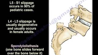 SpondylolysisSpondylolisthesisSpondylitis Spondylosis EverythingYou Need To Know Dr Nabil Ebraheim [upl. by Schild]