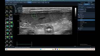 IQ 307 SPLEEN ECHOPAC ANALYSIS ULTRASOUND HWD 1 [upl. by Arodasi314]