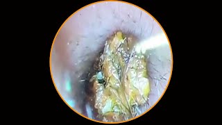 Satisfying Ear Wax Removal With Dr Zhao Video 34 [upl. by Aznaed]