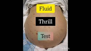 fluidthrilltestfluid wave test ascitesjalodarperitoneal disease [upl. by Saidnac]