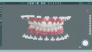 Orthodontic Application of Interproximal Updates in RealTime  IPC Updates in RealTime [upl. by Harutak]