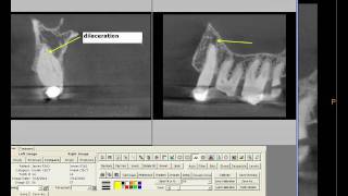 Creating CBCT Reports in TDO Software [upl. by Pearlman680]