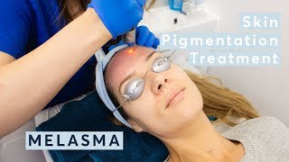 Melasma Skin Pigmentation Treatment using PicoSure Laser [upl. by Florina]