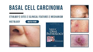 Basal cell carcinoma  Epithelial Pathology  Histology  Etiology  Oral Pathology [upl. by Ecirtahs52]