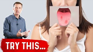 Burning Mouth Syndrome Demystified [upl. by Lehcir]