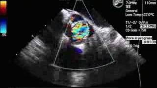 Quadleaflet Aortic Valve [upl. by Ybba]